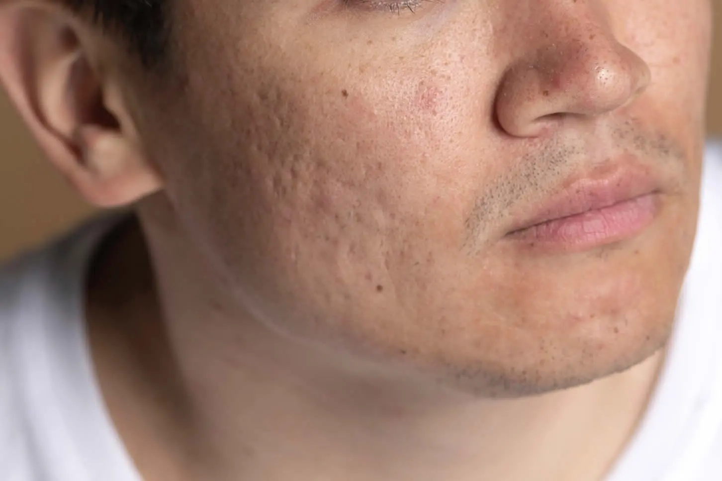 medical dermatology woman acne scars on face